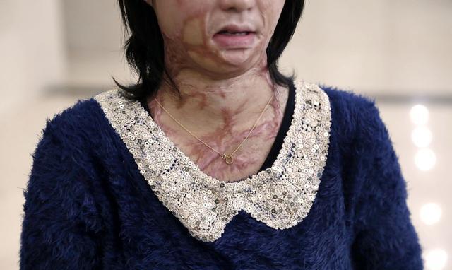 毁容女孩的新篇章，勇气与重生的力量故事更新中